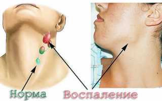 Боль в лимфоузлах